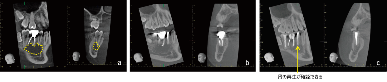 Case02　歯根嚢胞
