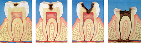 虫歯が進行する様子