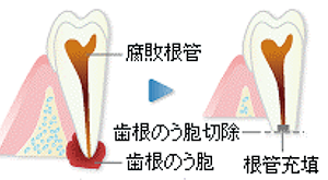 歯根端切除術